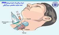  ارائه خدمت جدید سونوگرافی تخصصی و نمونه‌برداری (FNA) در بیمارستان امام خمینی (ره) فیروزکوه  بیمارستان امام خمینی (ره) فیروزکوه از آغاز به کار واحد تخصصی سونوگرافی و انجام نمونه‌برداری‌های ظریف تحت هدایت سونوگرافی (FNA) توسط متخصص رادیولوژی خبر داد.  به گزارش روابط عمومی بیمارستان؛ در راستای ارتقای خدمات تشخیصی و درمانی و کاهش مراجعات بیماران به پایتخت، واحد تصویربرداری این مرکز در روزهای چهارشنبه و پنجشنبه هر هفته، خدمات ویژه‌ای را در حوزه تشخیص توده‌ها و ندول‌های بدن ارائه می‌دهد.  ### تشخیص دقیق؛ گام نخس